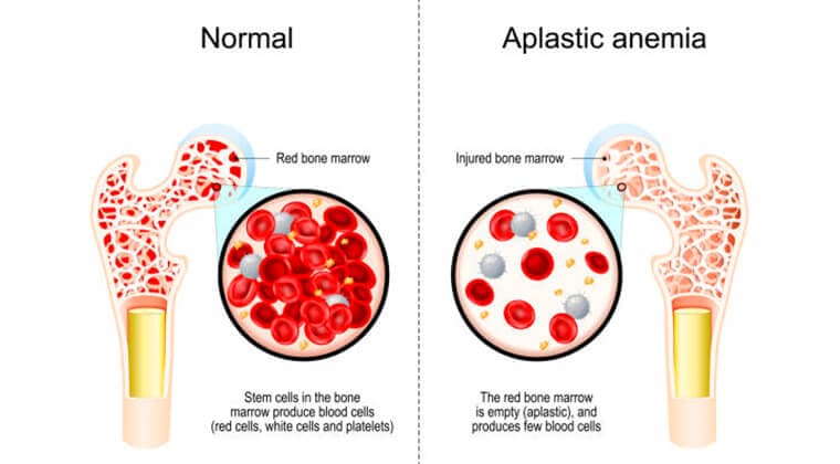 Anemia Aplásica