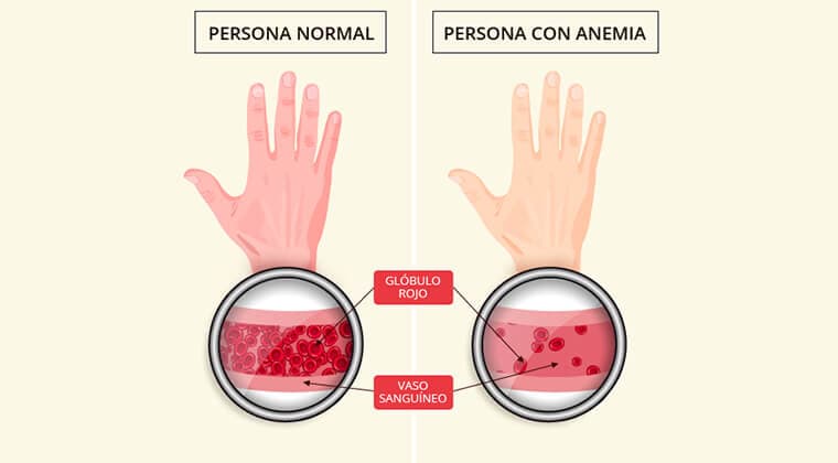 Anemia Ferropénica