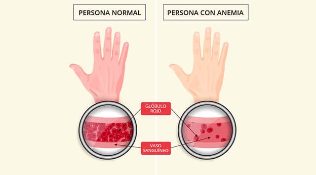 Anemia Ferropénica