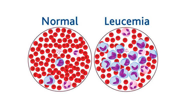 Leucemia