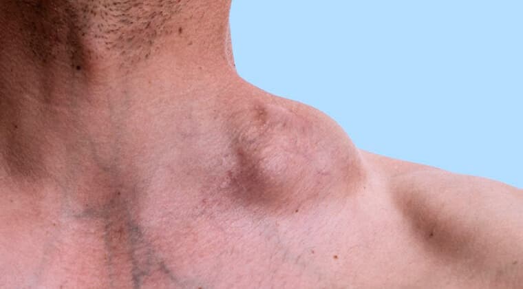 Linfoma