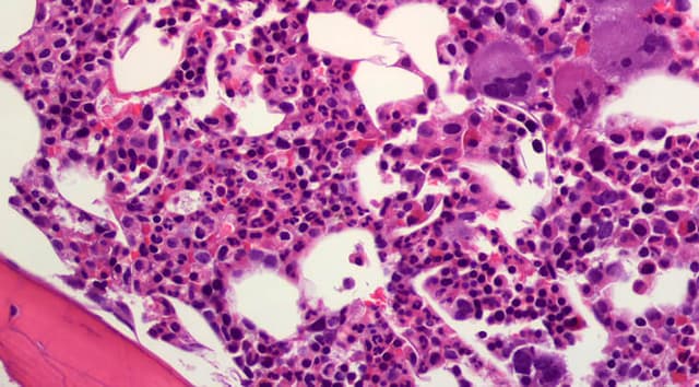 Trombocitemia Esencial