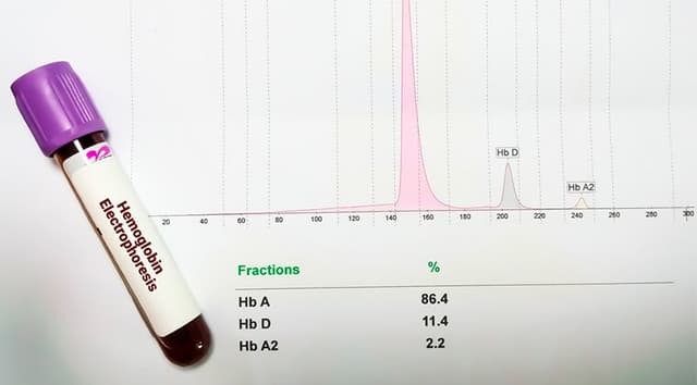 Electroforesis de Hemoglobina