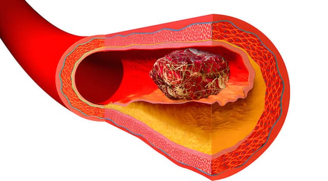 Trombosis y Hemostasia