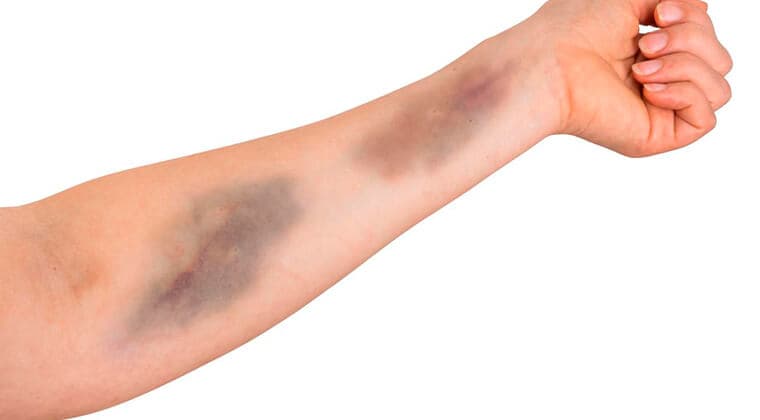 Hematomas Sin Causa Aparente